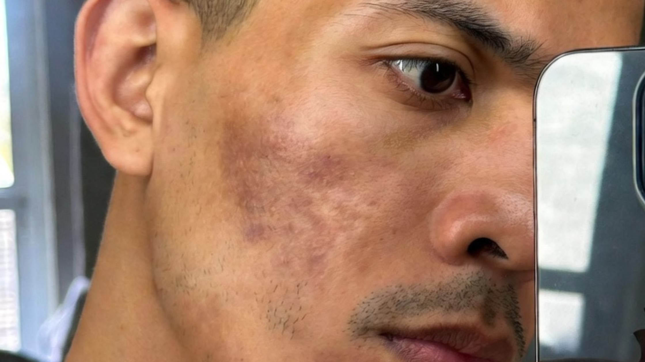 How to Fix Hyperpigmentation for Men