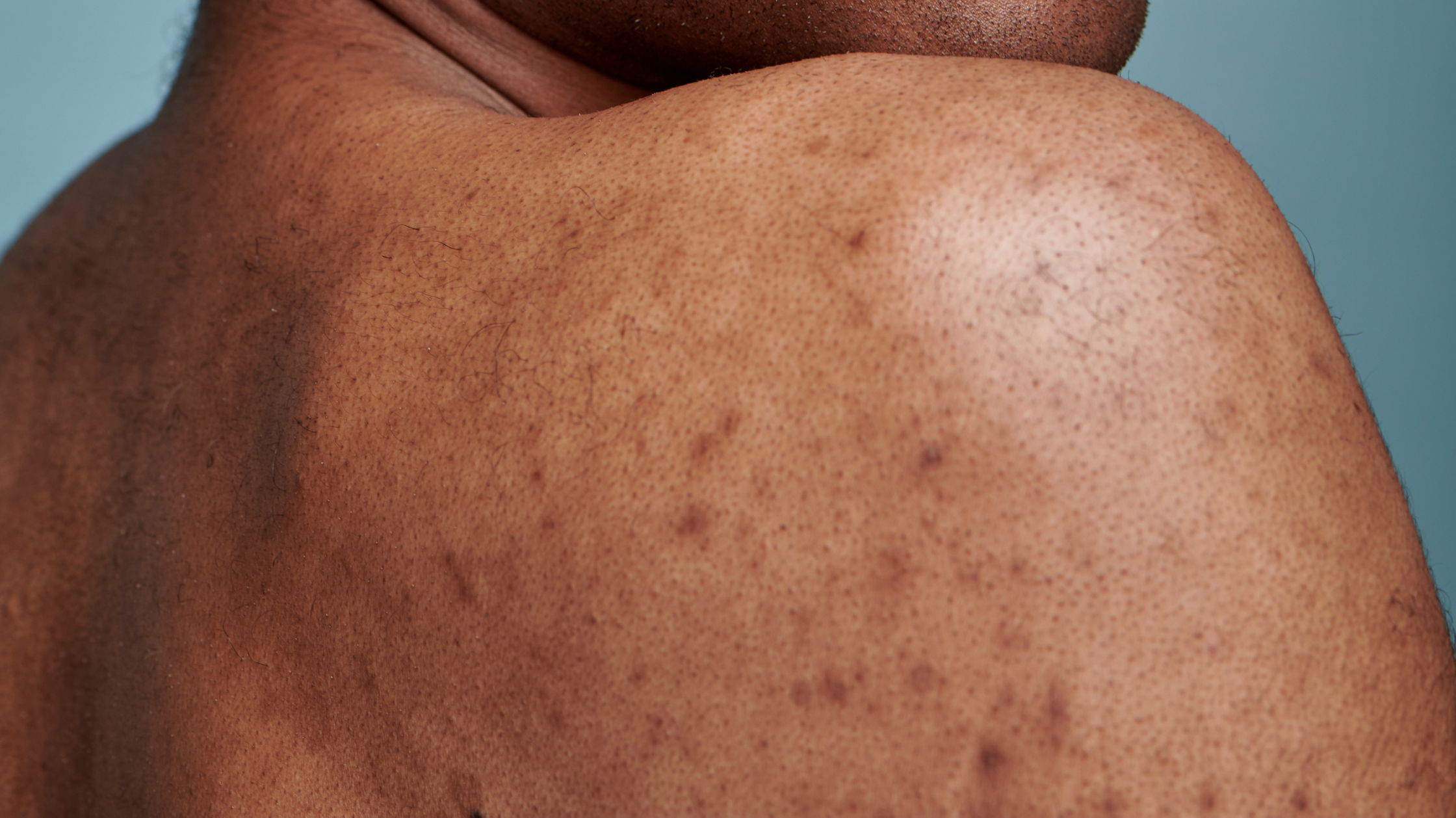 What is Hyperpigmentation in Men and How Do We Get It?